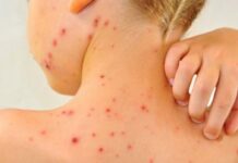 Epidemia de rujeolă – cauze, proteste, isterie mediatică și legătura cu cazurile de corupție