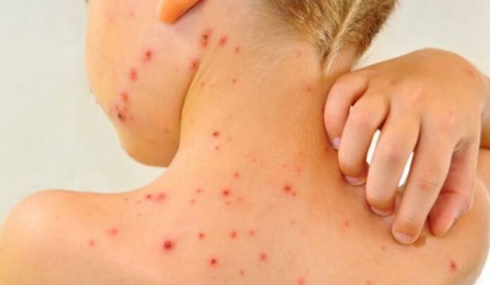 Epidemia de rujeolă – cauze, proteste, isterie mediatică și legătura cu cazurile de corupție