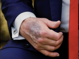 Experții se pronunță despre starea reală de sănătate a lui Donald Trump