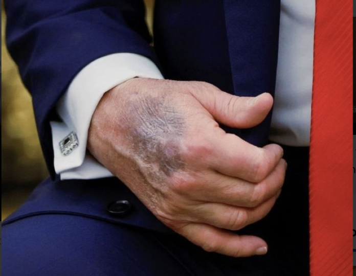 Experții se pronunță despre starea reală de sănătate a lui Donald Trump